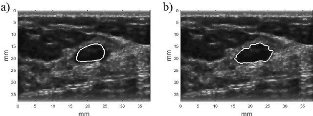 Figure 1 for Added value of morphological features to breast lesion diagnosis in ultrasound