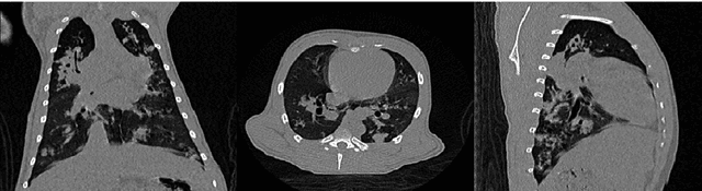 Figure 4 for PhD Thesis. Computer-Aided Assessment of Tuberculosis with Radiological Imaging: From rule-based methods to Deep Learning