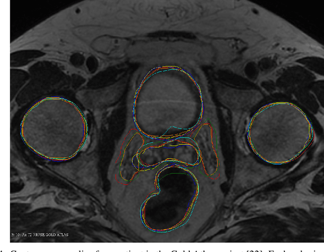 Figure 1 for On Image Segmentation With Noisy Labels: Characterization and Volume Properties of the Optimal Solutions to Accuracy and Dice