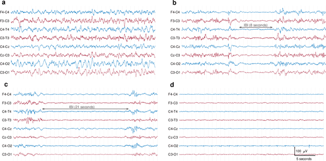 Figure 4 for Neonatal EEG graded for severity of background abnormalities in hypoxic-ischaemic encephalopathy
