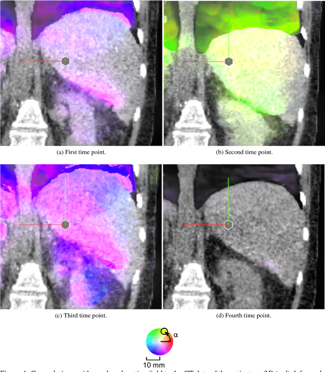Figure 4 for Interpatient Respiratory Motion Model Transfer for Virtual Reality Simulations of Liver Punctures