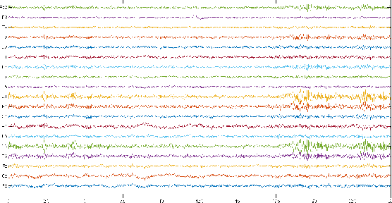 Figure 4 for Automatic Diagnosis of Schizophrenia using EEG Signals and CNN-LSTM Models