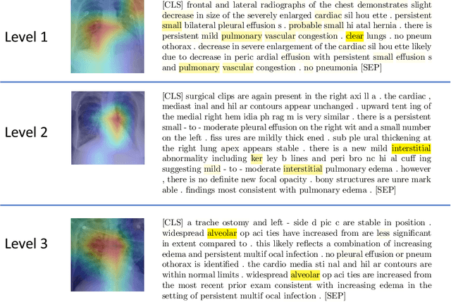 Figure 4 for Joint Modeling of Chest Radiographs and Radiology Reports for Pulmonary Edema Assessment