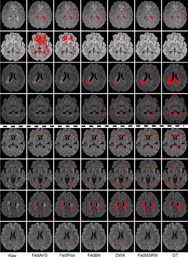 Figure 3 for MS Lesion Segmentation: Revisiting Weighting Mechanisms for Federated Learning