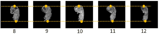 Figure 3 for Multi-Atlas Segmentation and Spatial Alignment of the Human Embryo in First Trimester 3D Ultrasound