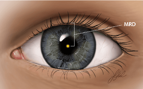 Figure 1 for AutoPtosis