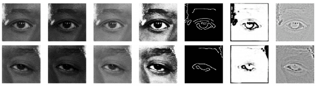 Figure 3 for AutoPtosis