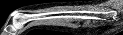 Figure 1 for Towards whole-body CT Bone Segmentation