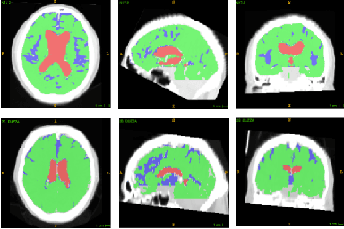 Figure 2 for Fully Automated Volumetric Classification in CT Scans for Diagnosis and Analysis of Normal Pressure Hydrocephalus