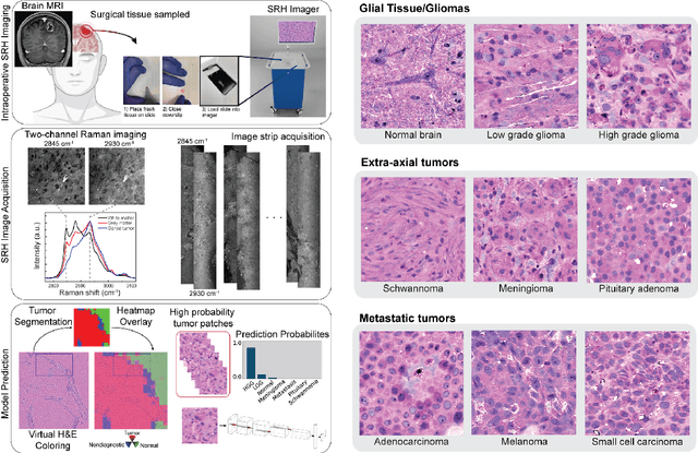 Figure 1 for OpenSRH: optimizing brain tumor surgery using intraoperative stimulated Raman histology