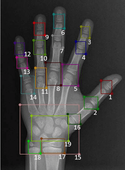 Figure 3 for An Unsupervised Deep-Learning Method for Bone Age Assessment