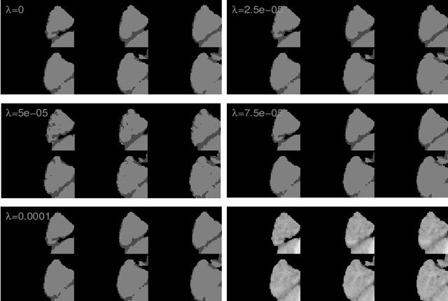 Figure 4 for Local semi-supervised approach to brain tissue classification in child brain MRI