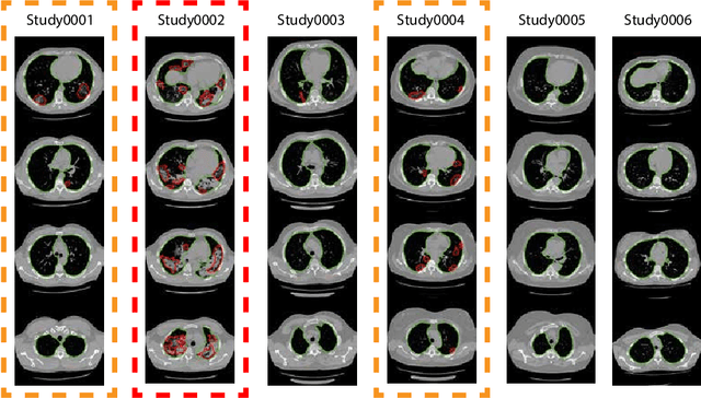 Figure 3 for CT-based COVID-19 Triage: Deep Multitask Learning Improves Joint Identification and Severity Quantification
