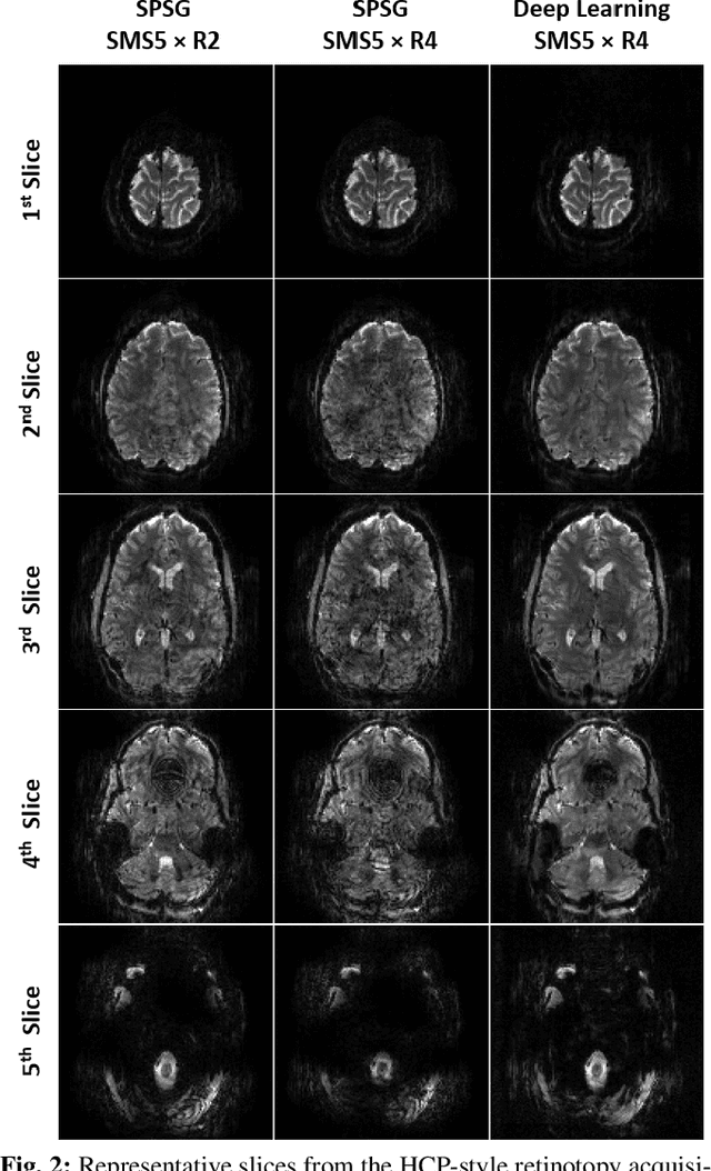 Figure 2 for 20-fold Accelerated 7T fMRI Using Referenceless Self-Supervised Deep Learning Reconstruction