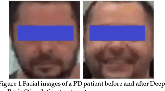 Figure 1 for Private Facial Diagnosis as an Edge Service for Parkinson's DBS Treatment Valuation