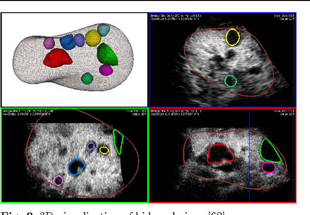 Figure 4 for 3D Ultrasound image segmentation: A Survey