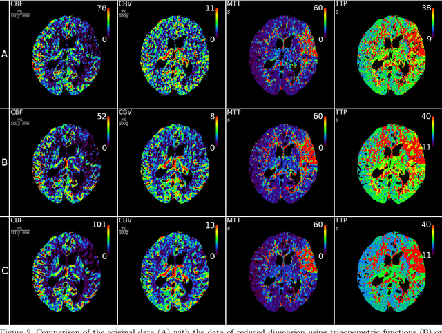 Figure 3 for Noise and dose reduction in CT brain perfusion acquisition by projecting time attenuation curves onto lower dimensional spaces