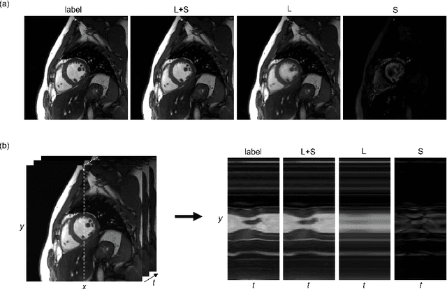 Figure 3 for Deep Low-rank plus Sparse Network for Dynamic MR Imaging