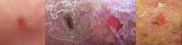 Figure 2 for Analysis Towards Classification of Infection and Ischaemia of Diabetic Foot Ulcers