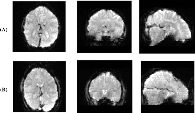 Figure 3 for Automatic Diagnosis of Schizophrenia and Attention Deficit Hyperactivity Disorder in rs-fMRI Modality using Convolutional Autoencoder Model and Interval Type-2 Fuzzy Regression
