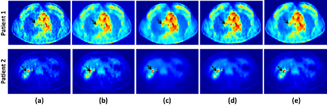 Figure 1 for Optimally Stabilized PET Image Denoising Using Trilateral Filtering