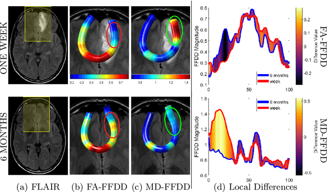 Figure 2 for Fiber-Flux Diffusion Density for White Matter Tracts Analysis: Application to Mild Anomalies Localization in Contact Sports Players
