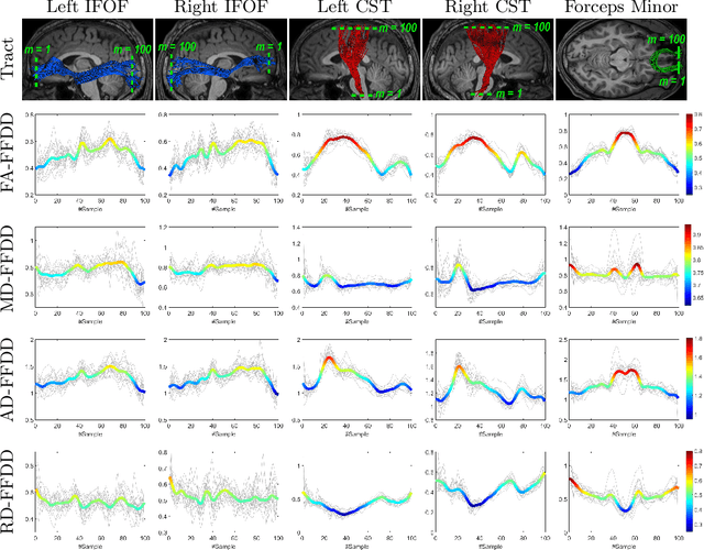 Figure 3 for Fiber-Flux Diffusion Density for White Matter Tracts Analysis: Application to Mild Anomalies Localization in Contact Sports Players