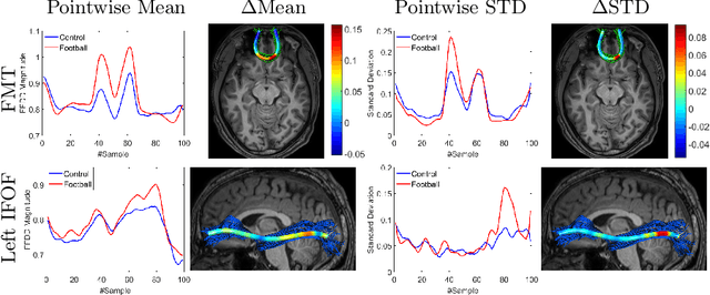 Figure 4 for Fiber-Flux Diffusion Density for White Matter Tracts Analysis: Application to Mild Anomalies Localization in Contact Sports Players