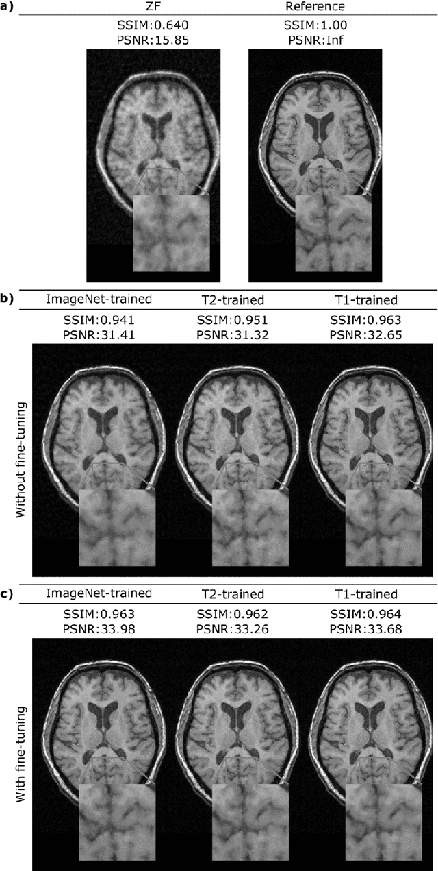 Figure 3 for A Transfer-Learning Approach for Accelerated MRI using Deep Neural Networks