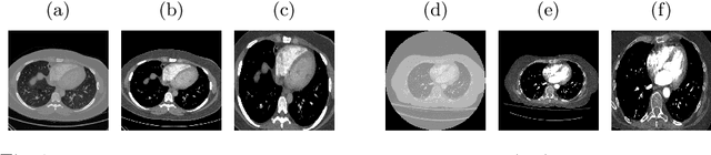 Figure 1 for Seeking an Optimal Approach for Computer-Aided Pulmonary Embolism Detection