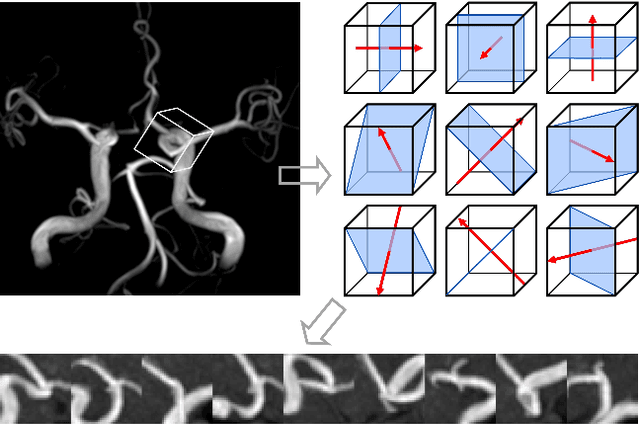 Figure 1 for A neural network model that learns differences in diagnosis strategies among radiologists has an improved area under the curve for aneurysm status classification in magnetic resonance angiography image series