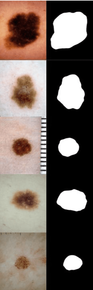Figure 1 for ISIC 2018-A Method for Lesion Segmentation