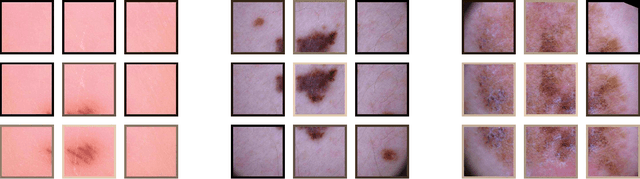 Figure 4 for Skin Lesion Classification Using CNNs with Patch-Based Attention and Diagnosis-Guided Loss Weighting
