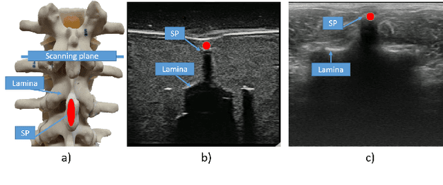 Figure 1 for Follow the Curve: Robotic-Ultrasound Navigation with Learning Based Localization of Spinous Processes for Scoliosis Assessment