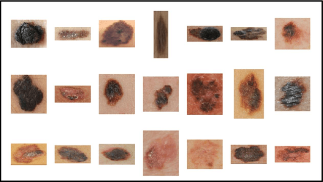 Figure 4 for Extended Feature Space-Based Automatic Melanoma Detection System