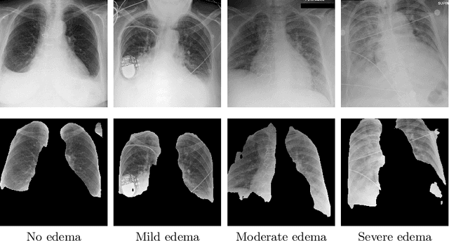 Figure 3 for Semi-supervised Learning for Quantification of Pulmonary Edema in Chest X-Ray Images