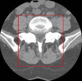 Figure 3 for Automatic Spine Segmentation using Convolutional Neural Network via Redundant Generation of Class Labels for 3D Spine Modeling