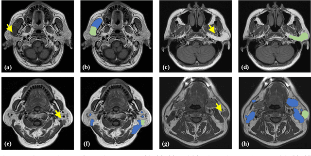 Figure 1 for An Anatomy-aware Framework for Automatic Segmentation of Parotid Tumor from Multimodal MRI