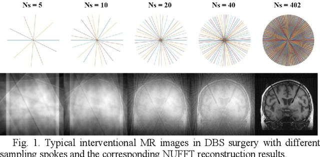 Figure 1 for A Long Short-term Memory Based Recurrent Neural Network for Interventional MRI Reconstruction
