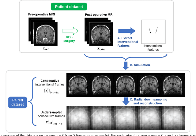 Figure 2 for A Long Short-term Memory Based Recurrent Neural Network for Interventional MRI Reconstruction