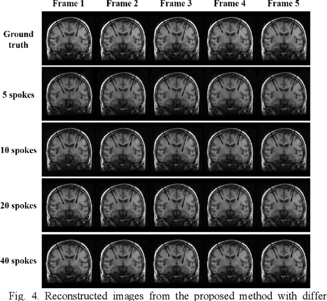 Figure 4 for A Long Short-term Memory Based Recurrent Neural Network for Interventional MRI Reconstruction