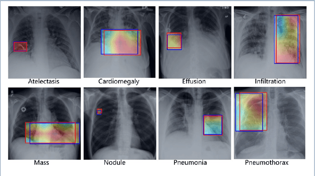 Figure 1 for Weighing Features of Lung and Heart Regions for Thoracic Disease Classification