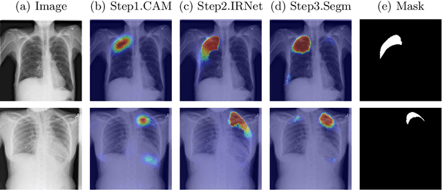 Figure 1 for Weakly-Supervised Segmentation for Disease Localization in Chest X-Ray Images