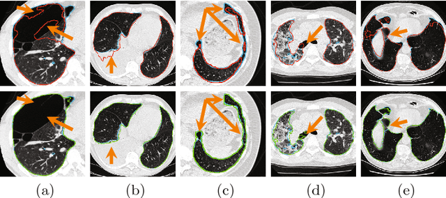 Figure 3 for Progressive and Multi-Path Holistically Nested Neural Networks for Pathological Lung Segmentation from CT Images