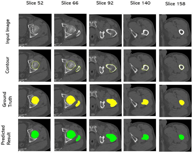 Figure 4 for A Deep Learning-Based Approach to Extracting Periosteal and Endosteal Contours of Proximal Femur in Quantitative CT Images
