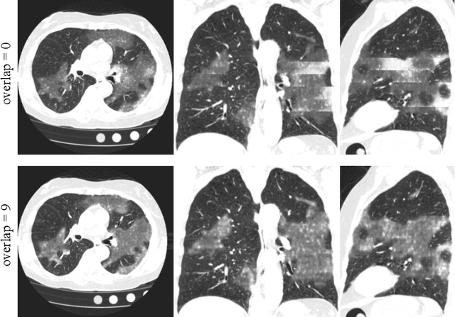 Figure 3 for 3D Tomographic Pattern Synthesis for Enhancing the Quantification of COVID-19