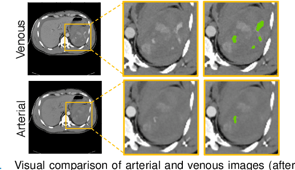 Figure 1 for External Attention Assisted Multi-Phase Splenic Vascular Injury Segmentation with Limited Data