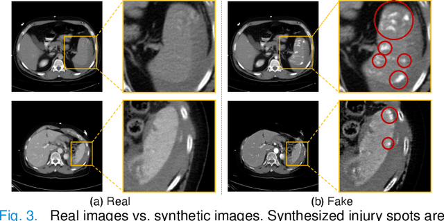 Figure 3 for External Attention Assisted Multi-Phase Splenic Vascular Injury Segmentation with Limited Data