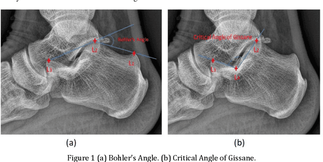 Figure 1 for Calcaneus Radiograph Analysis System: Calcaneal Angles Measurement and Fracture Identification