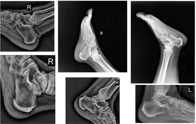 Figure 3 for Calcaneus Radiograph Analysis System: Calcaneal Angles Measurement and Fracture Identification